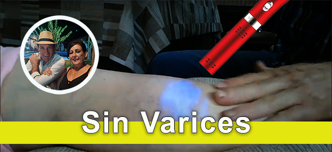 Elimina las varices con iTeraCare