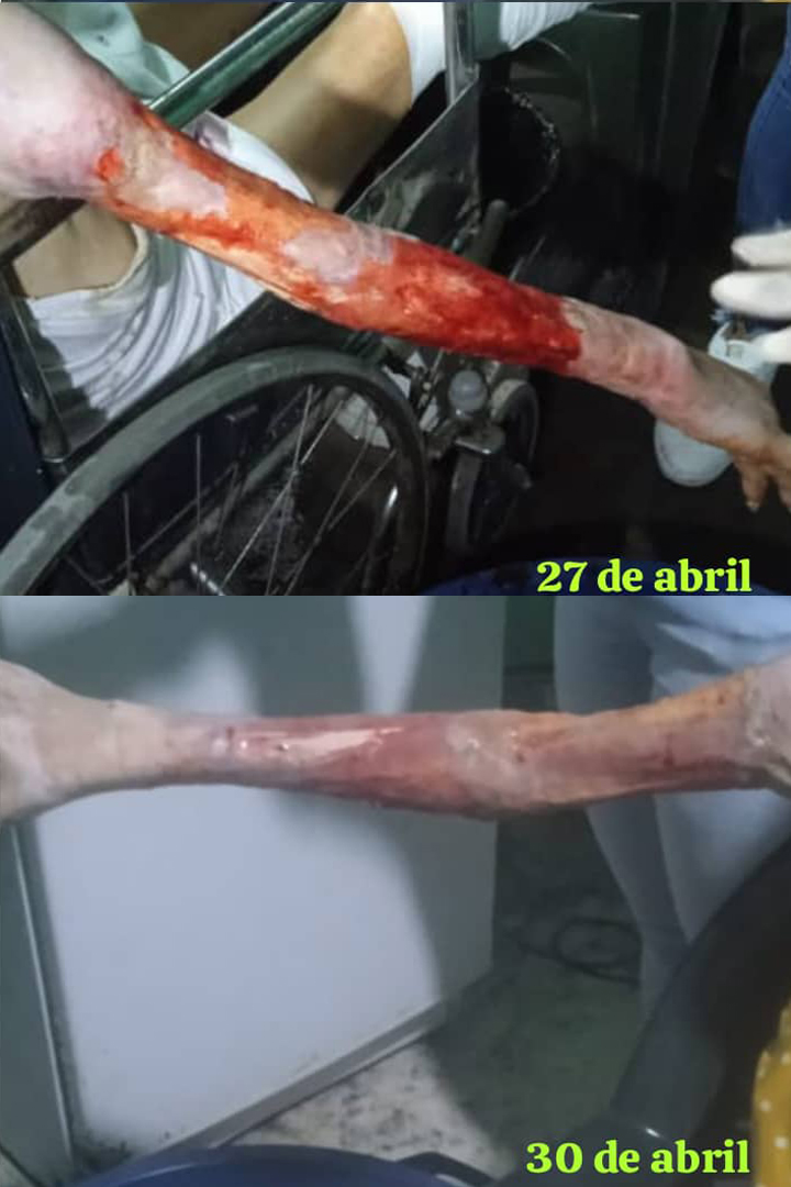 Milagro en Caja Seca: La Asombrosa Recuperación de Quemaduras con iTeraCare en Venezuela 3 brazo con quemadura de 3 grado tratadas con los dispositivos iteracare