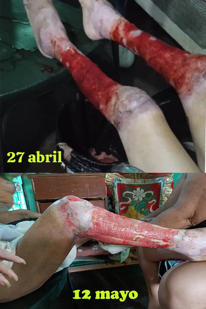 Milagro en Caja Seca: La Asombrosa Recuperación de Quemaduras con iTeraCare en Venezuela 4 pierna con quemadura de 3 grado tratadas con los dispositivos iteracare